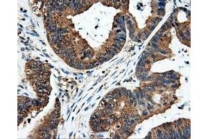 Immunohistochemical staining of paraffin-embedded Adenocarcinoma of colon tissue using anti-FAHD2Amouse monoclonal antibody.