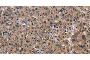 Immunohistochemistry of paraffin-embedded Human liver cancer tissue using KIF25 Polyclonal Antibody at dilution 1:40 (KIF25 antibody)