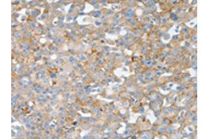 The image on the left is immunohistochemistry of paraffin-embedded Human breast cancer tissue using ABIN7190004(BPIFB2 Antibody) at dilution 1/50, on the right is treated with synthetic peptide. (BPIL1 antibody)