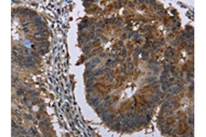 The image on the left is immunohistochemistry of paraffin-embedded Human colon cancer tissue using ABIN7129746(HSD17B6 Antibody) at dilution 1/20, on the right is treated with fusion protein. (HSD17B6 antibody)