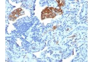 IHC testing of FFPE human lung carcinoma with DC-SIGN antibody (clone C209/1781). (DC-SIGN/CD209 antibody)