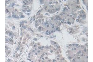 Detection of GPX3 in Human Pancreatic cancer Tissue using Polyclonal Antibody to Glutathione Peroxidase 3, Plasma (GPX3) (GPX3 antibody  (AA 21-72))