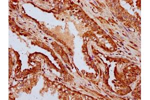IHC image of ABIN7156973 diluted at 1:400 and staining in paraffin-embedded human prostate cancer performed on a Leica BondTM system. (IFT172 antibody  (AA 1368-1502))