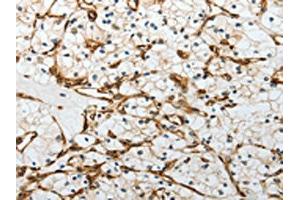 The image on the left is immunohistochemistry of paraffin-embedded Human renal cancer tissue using ABIN7193081(YBX1 Antibody) at dilution 1/15, on the right is treated with synthetic peptide. (YBX1 antibody)