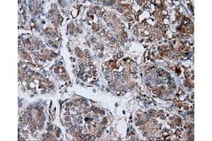 Immunohistochemical staining of paraffin-embedded Carcinoma of liver tissue using anti-LIPG mouse monoclonal antibody. (LIPG antibody)