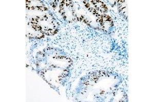 Immunohistochemistry (IHC) image for anti-SWI/SNF Related, Matrix Associated, Actin Dependent Regulator of Chromatin, Subfamily A, Member 4 (SMARCA4) antibody (ABIN7308346) (SMARCA4 antibody)