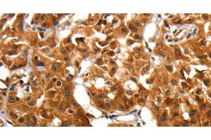 Immunohistochemistry of paraffin-embedded Human lung cancer using ADAP1 Polyclonal Antibody at dilution of 1:60 (ADAP1 antibody)