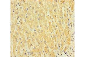 Immunohistochemistry of paraffin-embedded human liver cancer using ABIN7170610 at dilution of 1:100 (SPIN4 antibody  (AA 1-249))