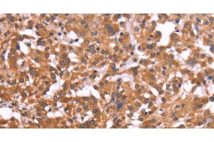 Immunohistochemistry of paraffin-embedded Human thyroid cancer tissue using CRISP3 Polyclonal Antibody at dilution 1:50 (CRISP3 antibody)