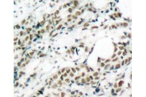 Immunohistochemistry of paraffin-embedded Human breast carcinoma tissue, using Phospho-FOXO4(S197) Polyclonal Antibody (FOXO4 antibody  (pSer197))