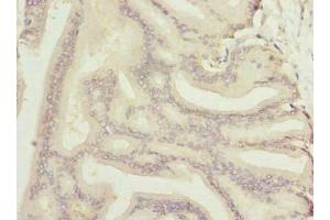 Immunohistochemistry of paraffin-embedded human prostate cancer using ABIN7161983 at dilution of 1:100 (Nucleolar Protein 6 antibody  (AA 951-1146))