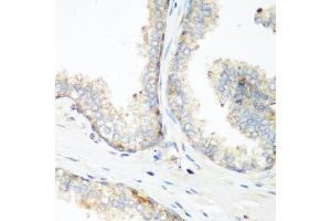 Immunohistochemistry of paraffin-embedded human prostate using NEDD4 antibody (ABIN1681009, ABIN3015207, ABIN3015208 and ABIN6213883) at dilution of 1:200 (40x lens). (NEDD4 antibody  (AA 160-460))