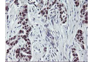 Immunohistochemical staining of paraffin-embedded Carcinoma of Human lung tissue using anti-ANKRD53 mouse monoclonal antibody. (ANKRD53 antibody  (AA 1-300))