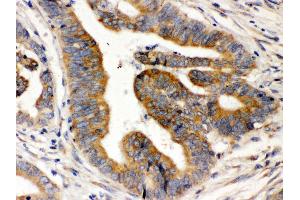 Anti-Rab5 Picoband antibody,IHC(P) IHC(P): Human Intestinal Cancer Tissue (RAB5 antibody  (C-Term))