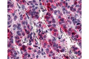 Anti-GPR1 antibody IHC of human Breast, Carcinoma.