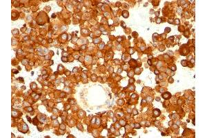 Formalin-fixed, paraffin-embedded human melanoma stained with CD63 Mouse Monoclonal Antibody (MX-49. (CD63 antibody)