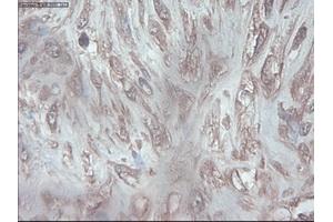 Immunohistochemical staining of paraffin-embedded Carcinoma of pancreas using anti-PDX1 (ABIN2452675) mouse monoclonal antibody. (PDX1 antibody)