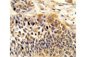 IHC analysis of FFPE human bladder carcinoma stained with WNT4 antibody (WNT4 antibody  (AA 211-239))