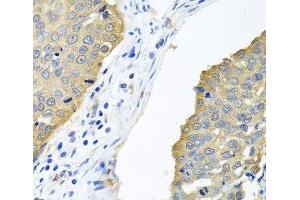 Immunohistochemistry of paraffin-embedded Human lung cancer using EIF4E Polyclonal Antibody at dilution of 1:100 (40x lens). (EIF4E antibody)