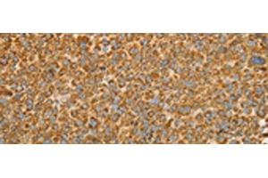 Immunohistochemistry of paraffin-embedded Human liver cancer tissue using VDAC2 Polyclonal Antibody at dilution of 1:25(x200) (VDAC2 antibody)