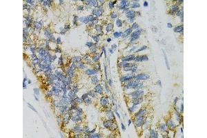 Immunohistochemistry of paraffin-embedded Human gastric cancer using SLC27A2 Polyclonal Antibody at dilution of 1:100 (40x lens). (SLC27A2 antibody)