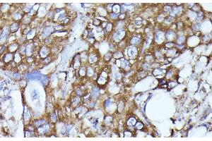 Immunohistochemistry of paraffin-embedded Human colon carcinoma using N-WASP Polyclonal Antibody at dilution of 1:100 (40x lens).