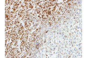 IHC-P Image Immunohistochemical analysis of paraffin-embedded SAS xenograft, using MTHFD2, antibody at 1:500 dilution. (MTHFD2 antibody)