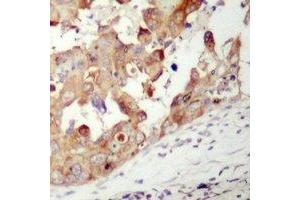 Immunohistochemical analysis of PAK1 staining in human prostate cancer formalin fixed paraffin embedded tissue section. (PAK1 antibody)