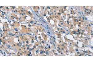 Immunohistochemistry of paraffin-embedded Human thyroid cancer tissue using GAS2 Polyclonal Antibody at dilution 1:50 (GAS2 antibody)