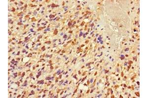 Immunohistochemistry of paraffin-embedded human glioma using ABIN7152681 at dilution of 1:100 (FRMD5 antibody  (AA 295-504))