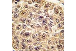 IHC analysis of FFPE human hepatocarcinoma tissue stained with anti-Ubiquitin antibody (Ubiquitin antibody  (AA 1-32))