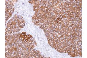 IHC-P Image Immunohistochemical analysis of paraffin-embedded DLD-1 xenograft , using MIPP , antibody at 1:500 dilution. (MINPP1 antibody)
