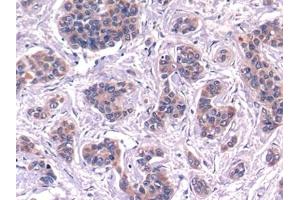 Detection of C4 in Human Liver cancer Tissue using Polyclonal Antibody to Complement Component 4 (C4) (Complement C4 antibody  (AA 975-1336))
