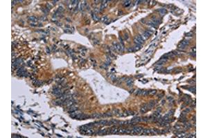 The image on the left is immunohistochemistry of paraffin-embedded Human colon cancer tissue using ABIN7128956(CLDND1 Antibody) at dilution 1/50, on the right is treated with fusion protein. (CLDND1 antibody)