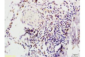 Formalin-fixed and paraffin embedded human colon carcinoma tissue with Anti-IFABP Polyclonal Antibody, Unconjugated  at 1:200, followed by conjugation to the secondary antibody and DAB staining (FABP2 antibody  (AA 45-132))