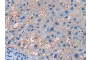 Detection of ITGb5 in Human Liver cancer Tissue using Polyclonal Antibody to Integrin Beta 5 (ITGb5) (Integrin beta 5 antibody  (AA 137-378))