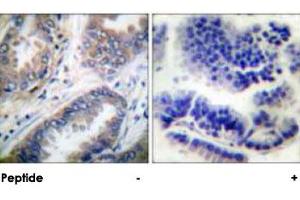 Immunohistochemical analysis of paraffin-embedded human lung carcinoma tissue using CASP9 polyclonal antibody .