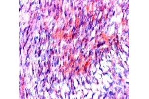 Formalin fixed paraffin embedded human stromal tumor stained with CD117 / c-kit antibody.