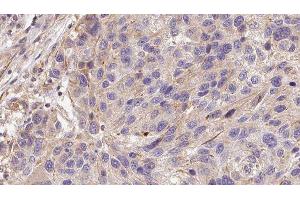 ABIN6278573 at 1/100 staining Human melanoma tissue by IHC-P.