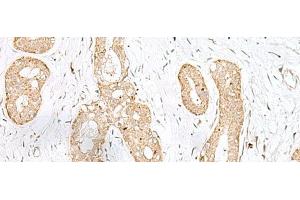 Immunohistochemistry of paraffin-embedded Human breast cancer tissue using BEX2 Polyclonal Antibody at dilution of 1:45(x200) (BEX2 antibody)