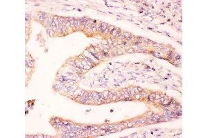 IHC-P: MCL1 antibody testing of human intestine cancer tissue (MCL-1 antibody  (AA 1-350))