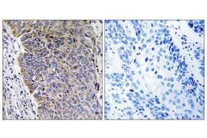 Immunohistochemistry analysis of paraffin-embedded human lung carcinoma tissue using MGST3 antibody. (MGST3 antibody  (N-Term))