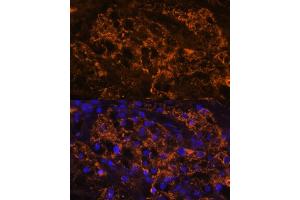 Immunofluorescence analysis of human kidney cancer using SLC7 antibody (ABIN6130697, ABIN6148048, ABIN6148049 and ABIN6216625) at dilution of 1:100. (SLC7A9 antibody  (AA 1-100))