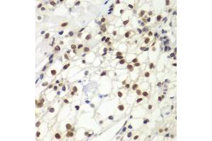 Immunohistochemistry of paraffin-embedded human kidney cancer using MSH6 antibody (ABIN5970371) at dilution of 1/100 (40x lens). (MSH6 antibody)