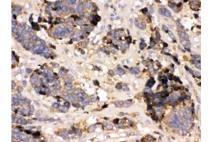 Anti- Prealbumin Picoband antibody,IHC(P) IHC(P): Human Lung Cancer Tissue (TTR antibody  (AA 21-147))
