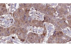 ABIN6269005 at 1/100 staining Human liver cancer tissue by IHC-P. (Metabotropic Glutamate Receptor 4 antibody  (C-Term))