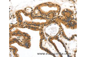 Immunohistochemistry of Human thyroid cancer using SERPINB8 Polyclonal Antibody at dilution of 1:40
