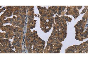 Immunohistochemistry of paraffin-embedded Human ovarian cancer tissue using GYS2 Polyclonal Antibody at dilution 1:50 (Glycogen Synthase 2 antibody)