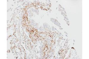 IHC-P Image Immunohistochemical analysis of paraffin-embedded human lung fibrose tissue, using SGLT1, antibody at 1:100 dilution. (SLC5A1 antibody  (Center))