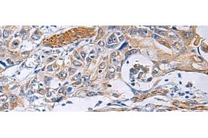 Immunohistochemistry of paraffin-embedded Human esophagus cancer tissue using FBXO45 Polyclonal Antibody at dilution of 1:40(x200) (FBXO45 antibody)